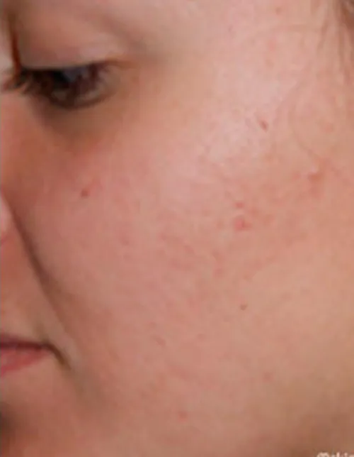 after treatment after treatment