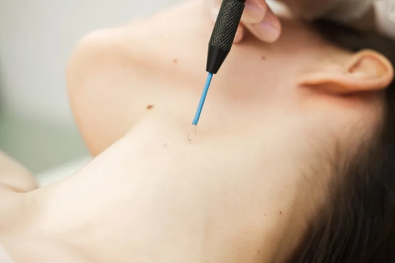 Mole Removal