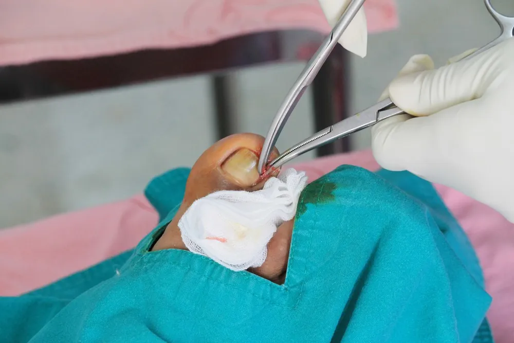 Nail Surgery