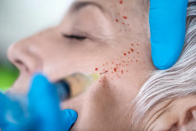 PRP for Skin