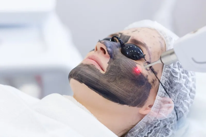 Q-Switched Nd:YAG Laser