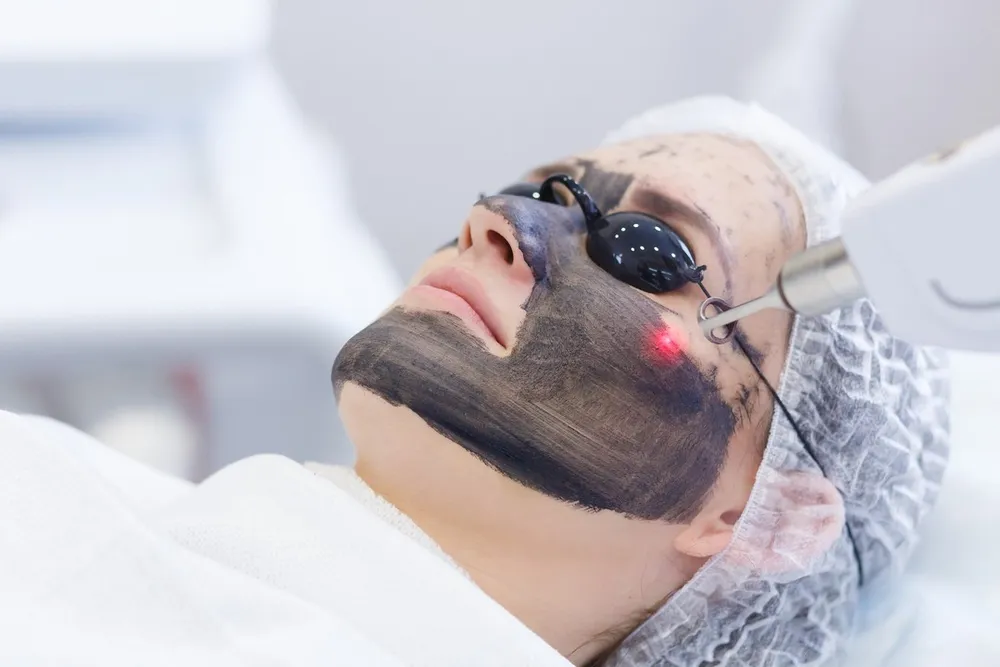 Q-Switched Nd:YAG Laser