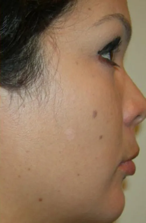 after treatment