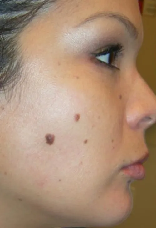 before treatment